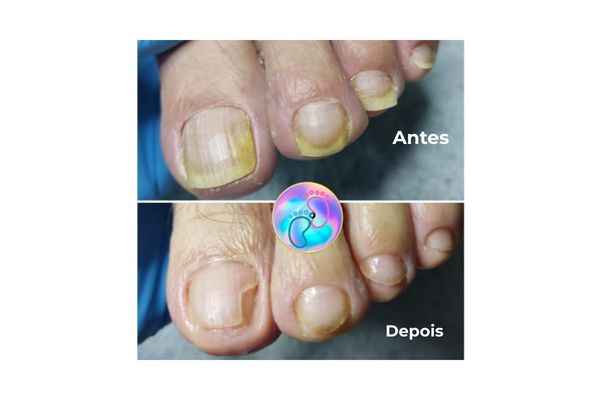 Foto de antes e depois do tratamento 17